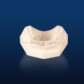 Customized Metal on Porcelain Denture